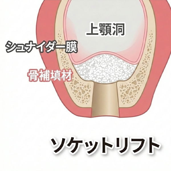 高松市仏生山町のインプラント治療