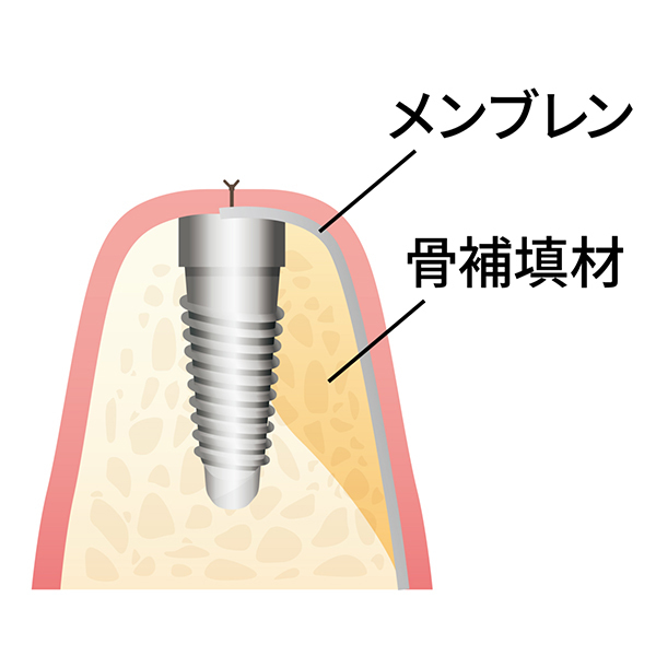 高松市仏生山町のインプラント治療